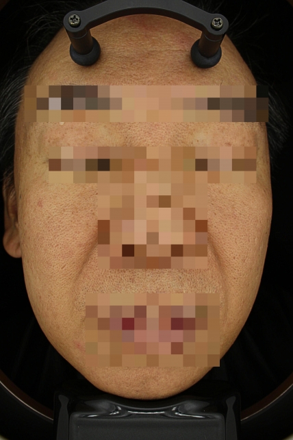 기미·색소 치료 후 대표 사진 23