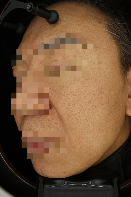 기미·색소 치료 후 사진 02