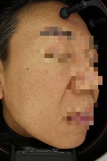 기미·색소 치료 후 사진 03
