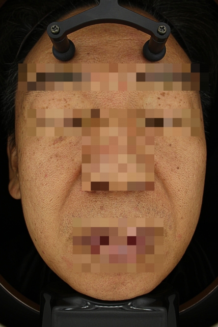 기미·색소 치료 전 대표 사진 23