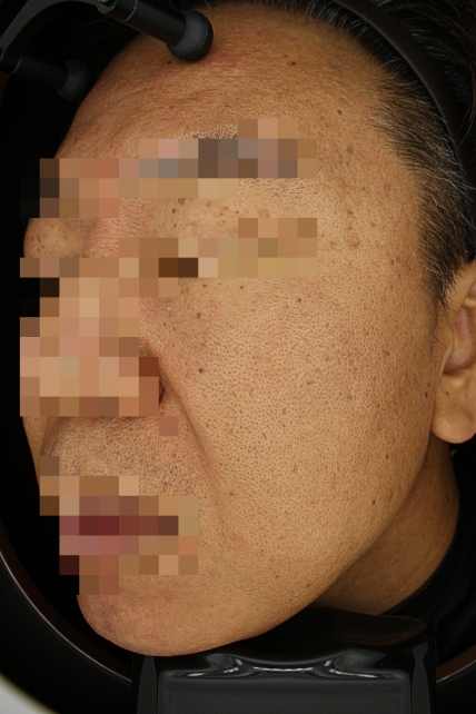 기미·색소 치료 전 사진 02