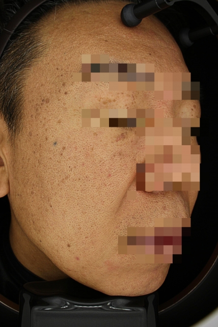 기미·색소 치료 전 사진 03