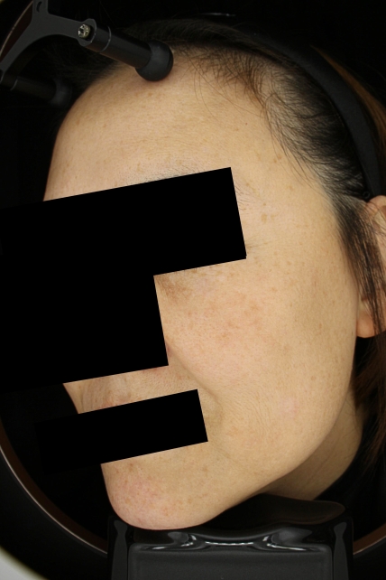 기미·색소 치료 후 대표 사진 25