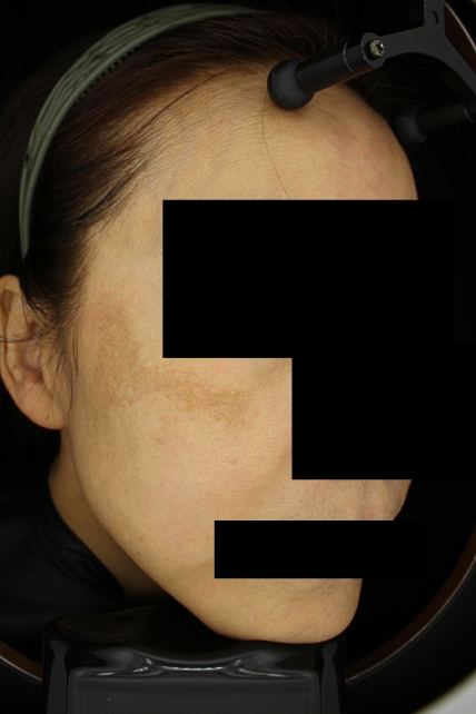 기미·색소 치료 전 사진 03