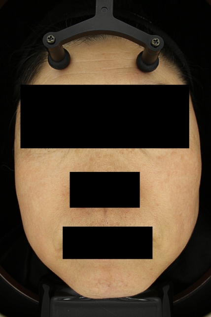 기미·색소 치료 후 대표 사진 27