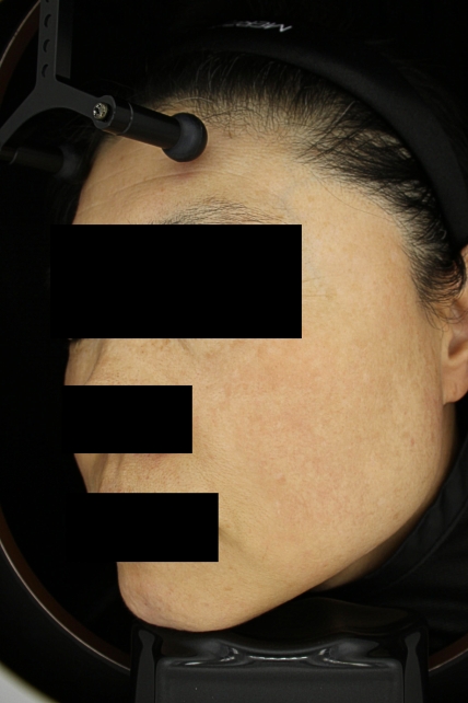 기미·색소 치료 후 사진 02