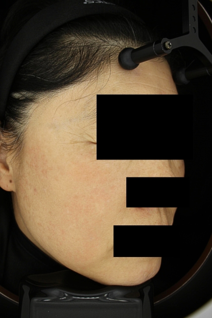 기미·색소 치료 후 사진 03