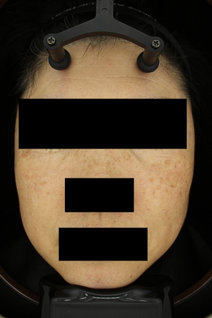 기미·색소 치료 전 대표 사진 27