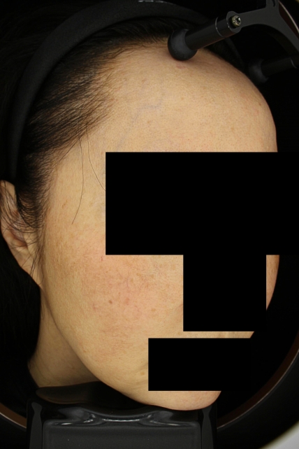 기미·색소 치료 전 대표 사진 28