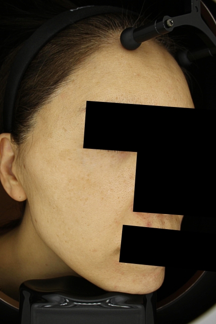 기미·색소 치료 후 사진 03