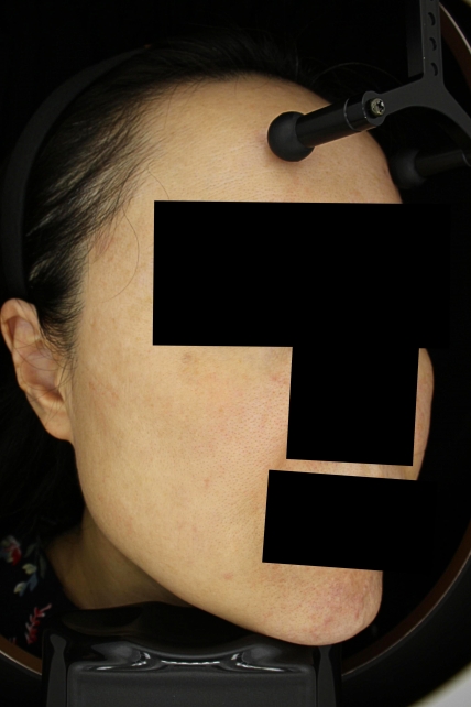 기미·색소 치료 후 사진 03