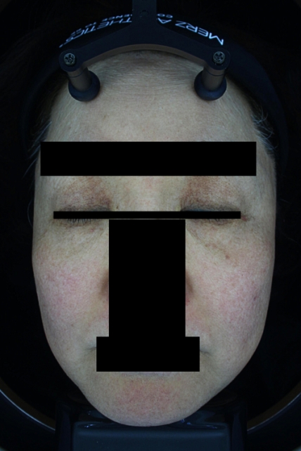 기미·색소 치료 후 대표 사진 35