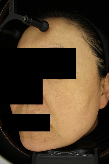 기미·색소 치료 후 사진 02