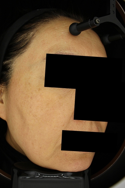 기미·색소 치료 후 사진 03