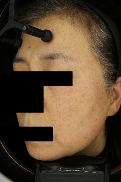 기미·색소 치료 후 사진 02