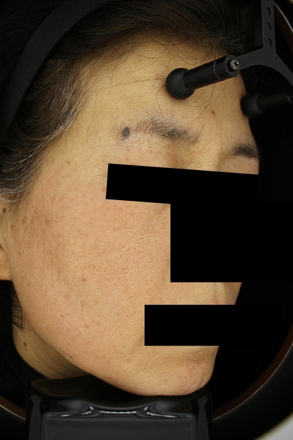 기미·색소 치료 후 사진 03