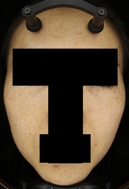 기미·색소 치료 전 대표 사진 39
