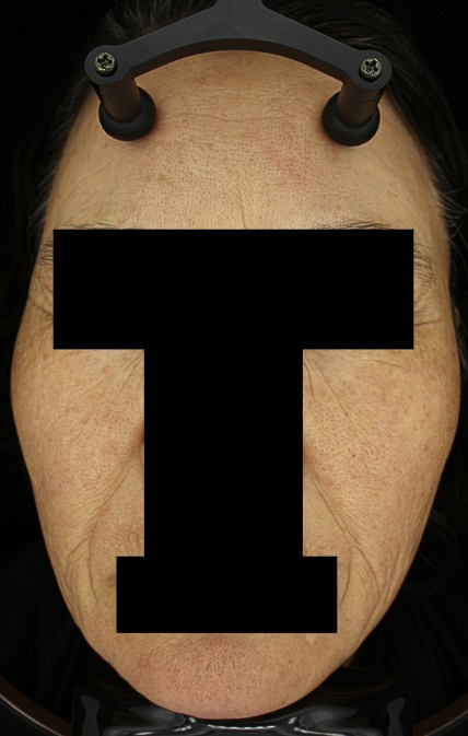 기미·색소 치료 후 대표 사진 40
