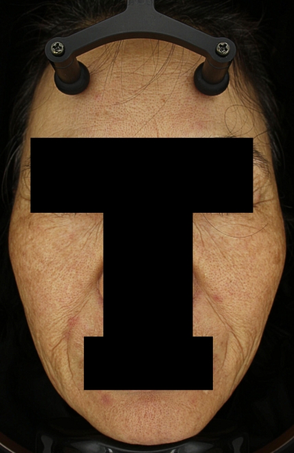 기미·색소 치료 전 대표 사진 40