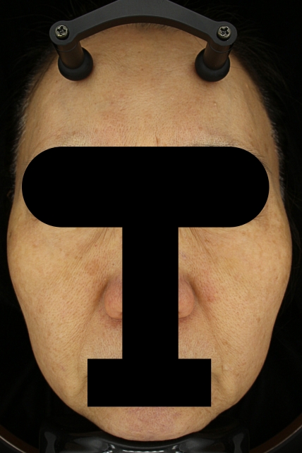 기미·색소 치료 후 대표 사진 41