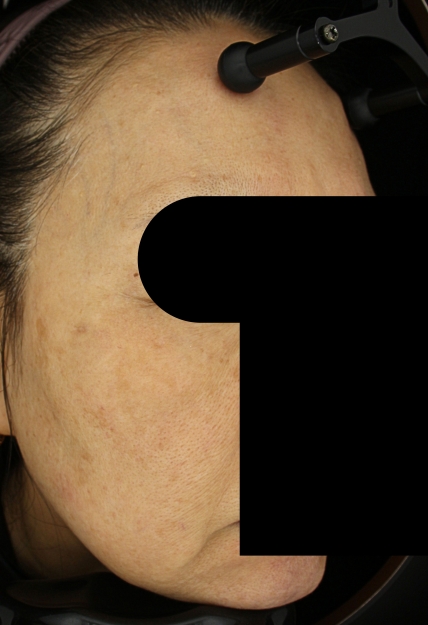기미·색소 치료 후 사진 03