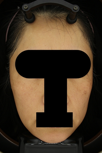 기미·색소 치료 후 대표 사진 42