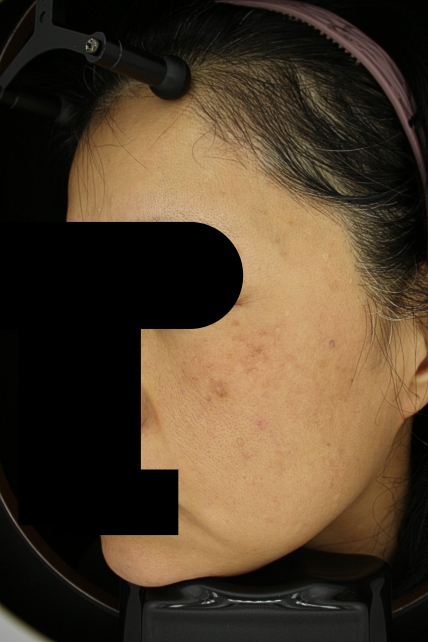 기미·색소 치료 후 사진 02