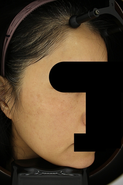 기미·색소 치료 후 사진 03
