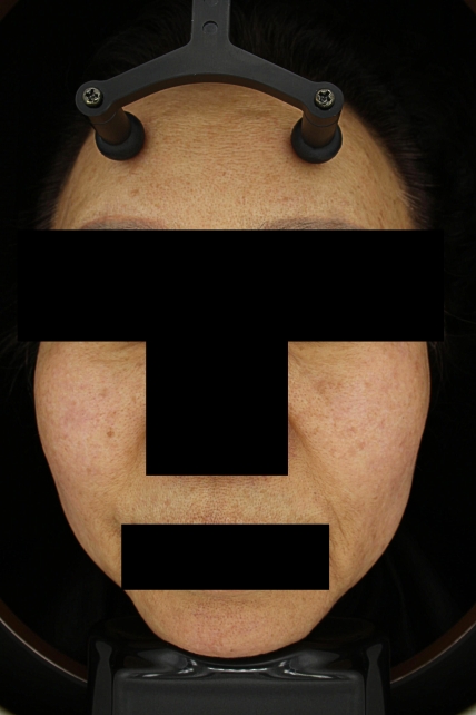기미·색소 치료 후 대표 사진 43