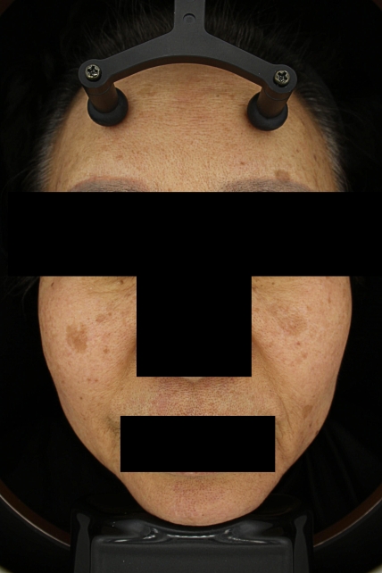 기미·색소 치료 전 대표 사진 43