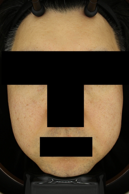 기미·색소 치료 후 대표 사진 44