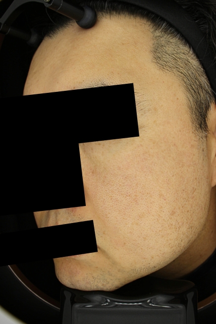 기미·색소 치료 후 사진 02