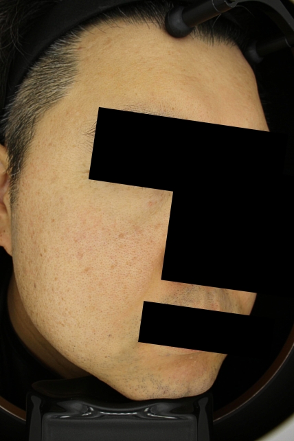 기미·색소 치료 후 사진 03
