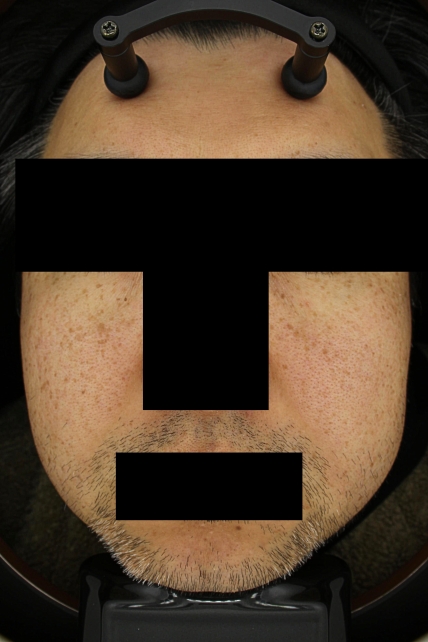 기미·색소 치료 전 대표 사진 44