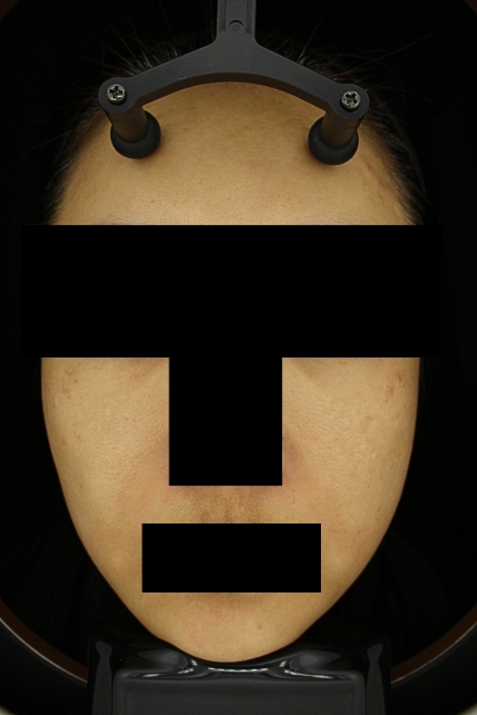 기미·색소 치료 후 대표 사진 45