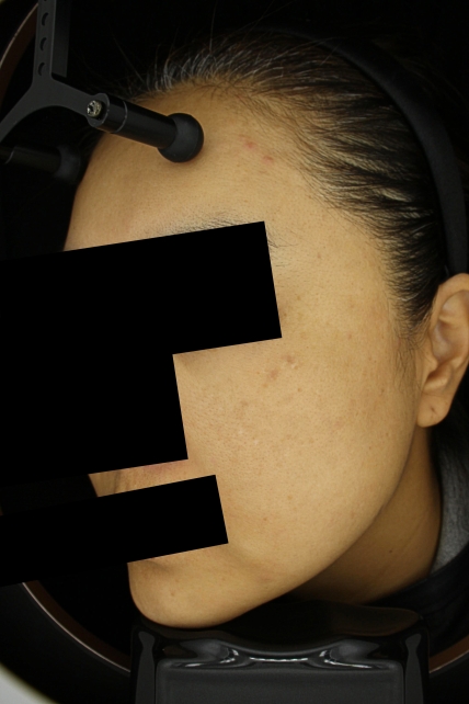 기미·색소 치료 후 사진 02