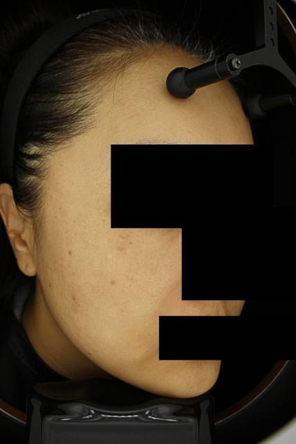 기미·색소 치료 후 사진 03