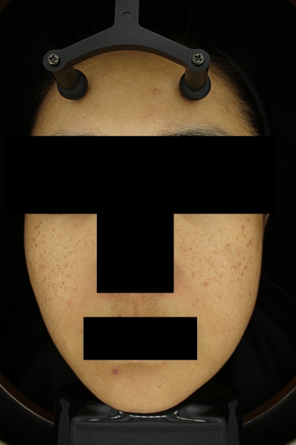 기미·색소 치료 전 대표 사진 45