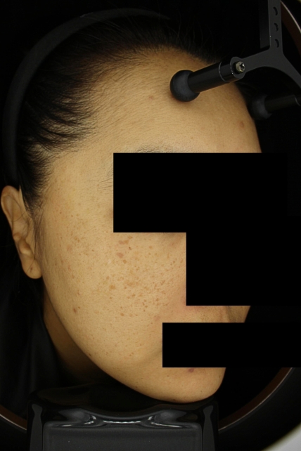 기미·색소 치료 전 사진 03