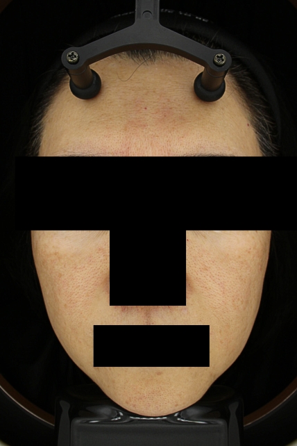 기미·색소 치료 후 대표 사진 46