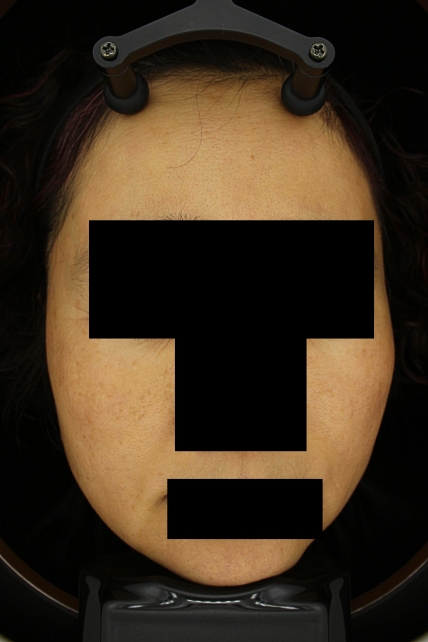 기미·색소 치료 후 대표 사진 47