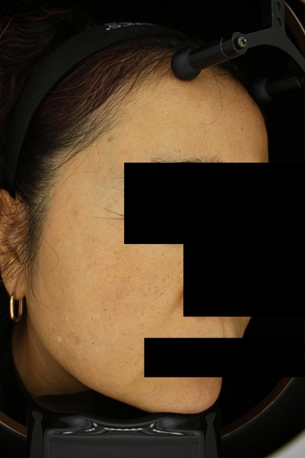 기미·색소 치료 후 사진 03
