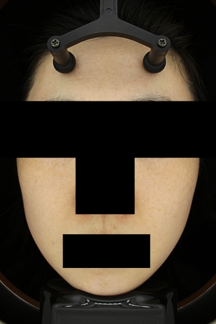 기미·색소 치료 후 대표 사진 49