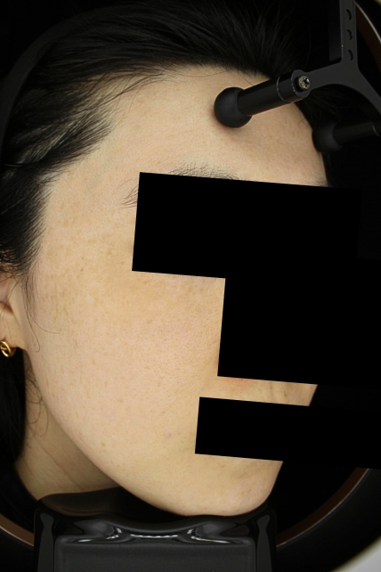 기미·색소 치료 후 사진 03