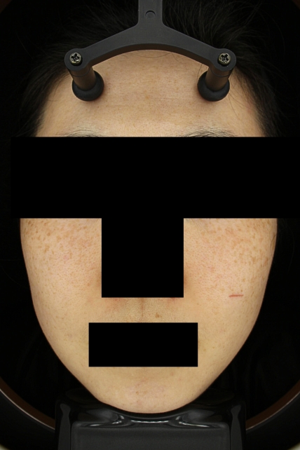 기미·색소 치료 전 대표 사진 49