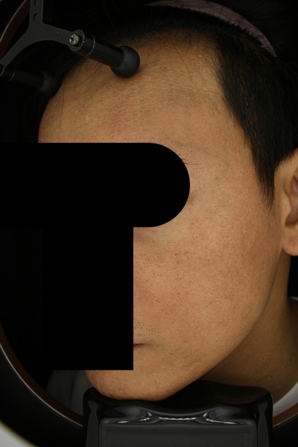 기미·색소 치료 후 사진 02