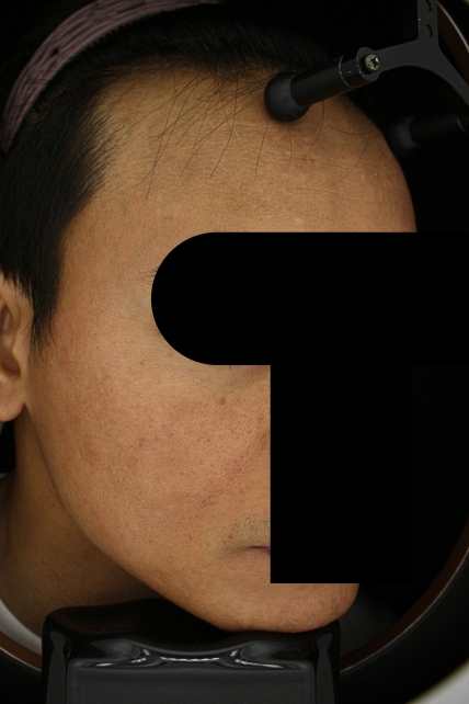 기미·색소 치료 후 사진 03