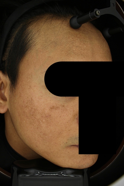 기미·색소 치료 전 사진 03