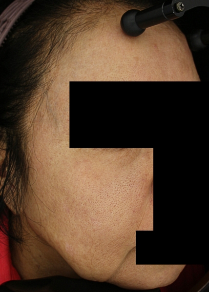 기미·색소 치료 후 사진 03