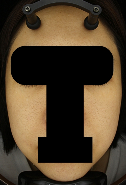 기미·색소 치료 후 대표 사진 55